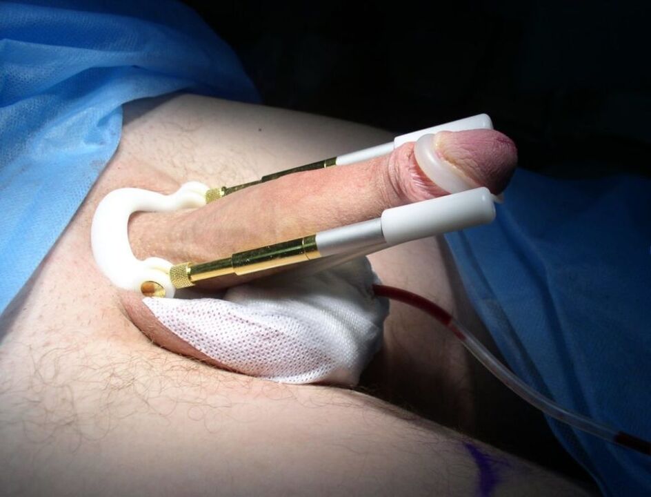 stretching after penis enlargement surgery