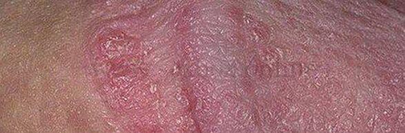 Dry skin and ulcers on the tip of the penis after using baking soda