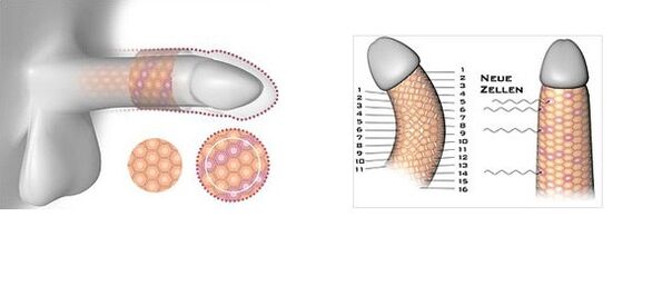 Results of surgery to increase penis size