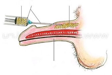 penis enlargement injections