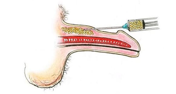 Muscle tissue implantation to increase penis size