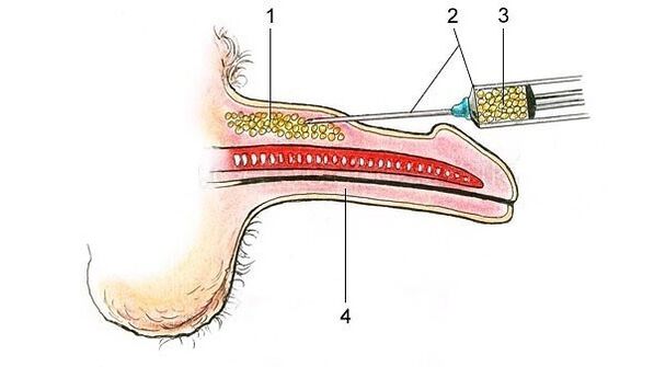 Hyaluronic acid injections to thicken the penis