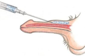 Dangerous penis enlargement method by injecting Vaseline